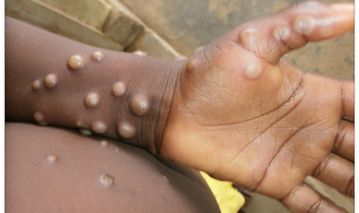 Nigeria , monkeypox cases, deaths, NCDC