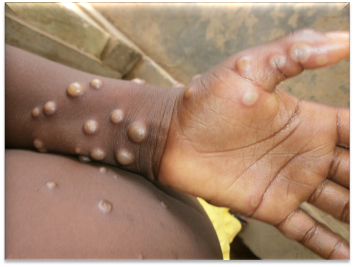 Nigeria , monkeypox cases, deaths, NCDC