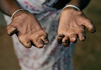 World Leprosy Day, Neglected Tropical Diseases ,WHO, stigma