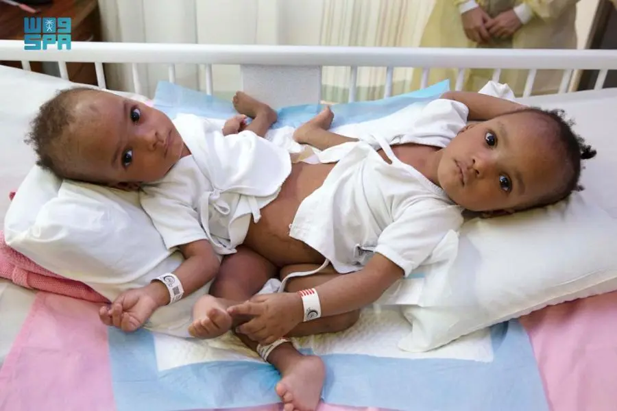 Surgery, Nigerian, siamese twins, Saudi Arabia