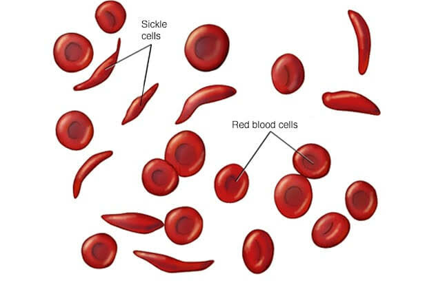 Sickle Cell disorder, divorce
